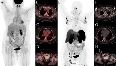 Case report: Uncommon multiple metastases from occult breast cancer revealed by 68Ga-DOTATATE PET/CT